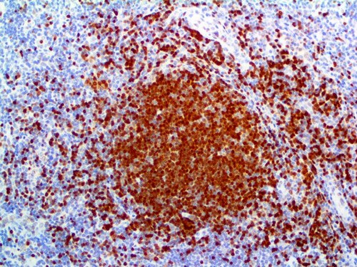 IHC of TCL1 on an FFPE Lymphoma Tissue